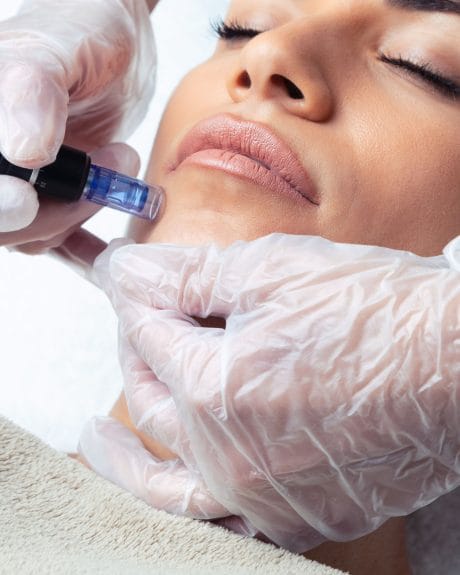 Microneedling